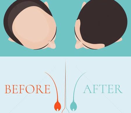 hair loss treatment
