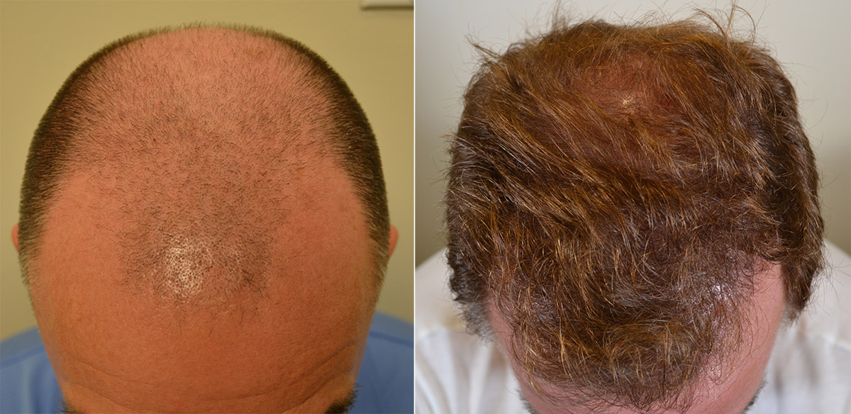 Follicular Unit Extraction FUE Hair Transplant Surgery
