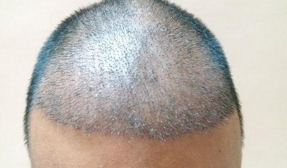 Everything you should know about Hair Transplant