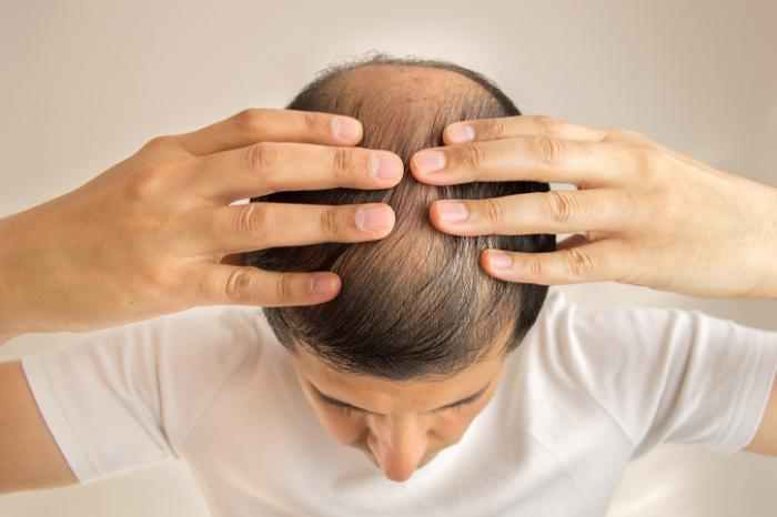 Is Hair Transplant Surgery Better Than Medication?