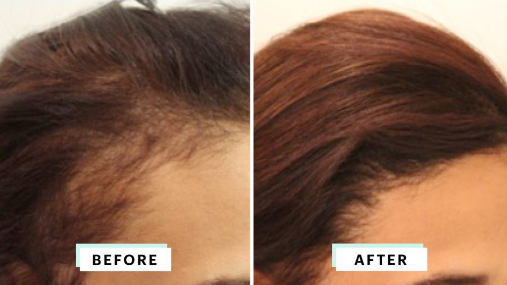 Women Hair Transplant - Is Hair Transplant Permanent?