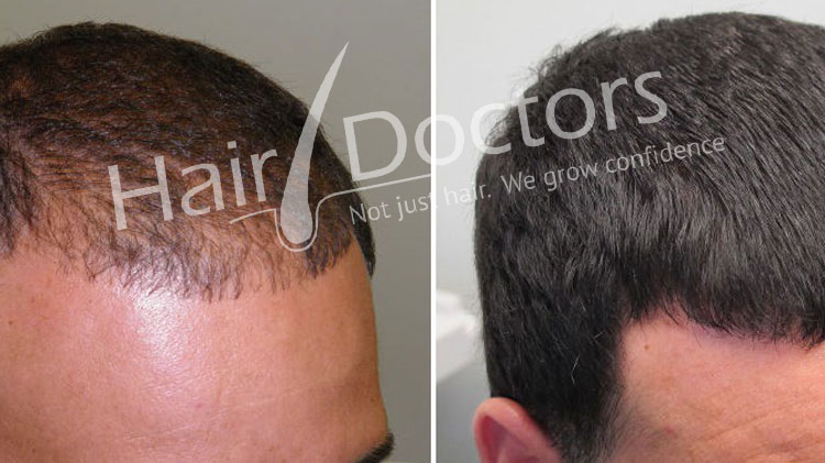 Hair Transplant in Cuddalore