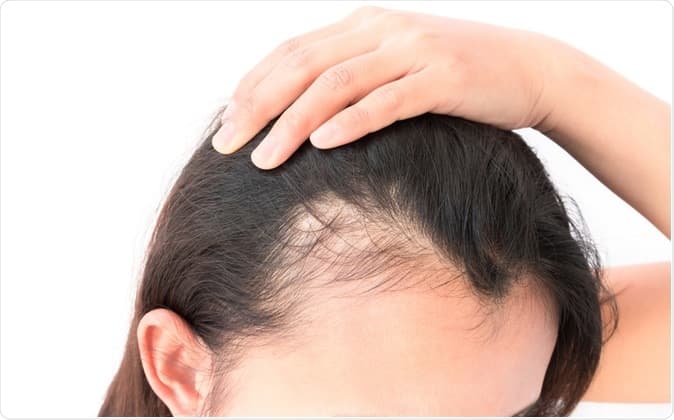 Baldness before hair transplant