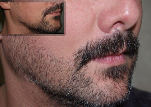 Facial Hair Transplant  Treatment and procedure in Mysore  Reniu Clinic