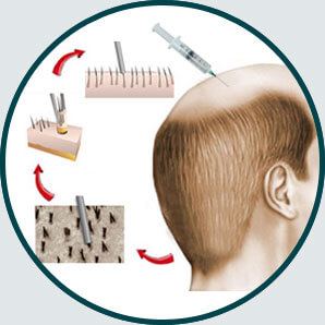 BIO FUE Hair Transplant