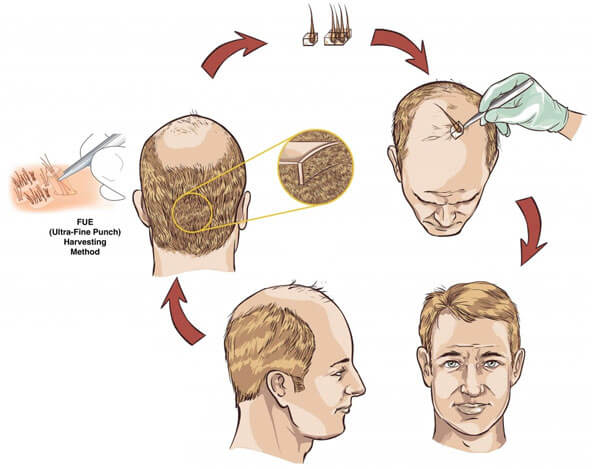 FUE Hair Transplant