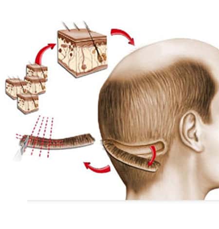 FUT Hair Transplant