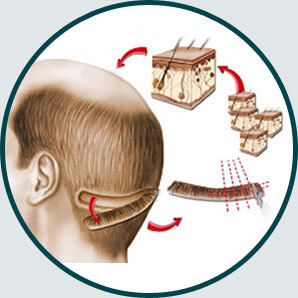 FUT Hair Transplant