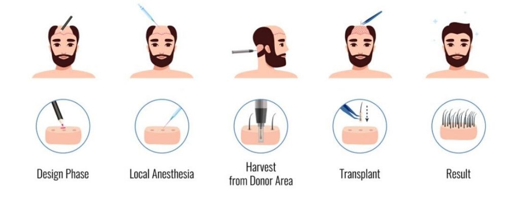 Hair Transplant Procedure