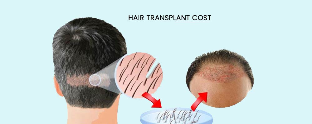 Hair Transplant in Chennai - Hair Loss Treatment Cost & Clinics