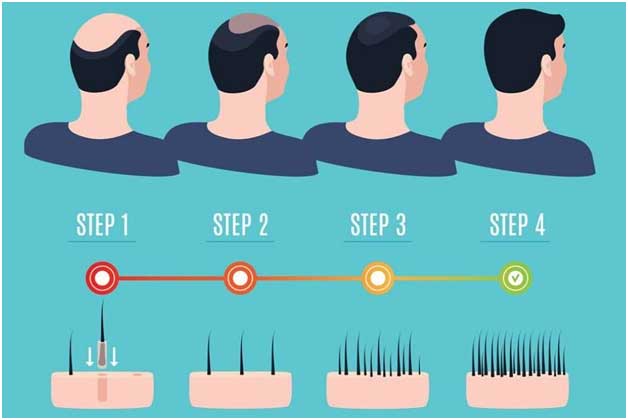 Hair Transplant Procedure