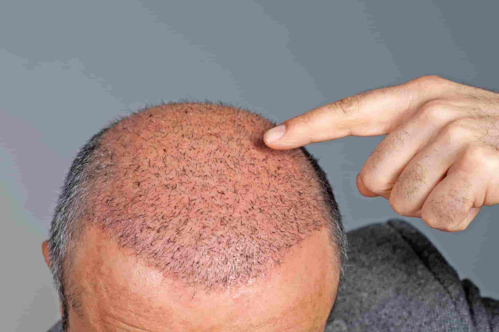 Baldhead Patient for hair transplant