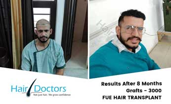 Hair Transplant Results