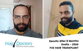 Hair Transplant Results