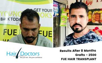 Hair Transplant Results