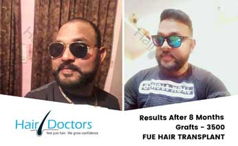 Hair Transplant Results
