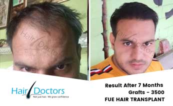 Hair Transplant Results