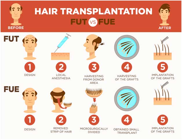 Hair Transplant Method