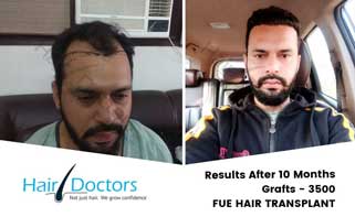 Hair Transplant in Amritsar - Clinics, Cost & Treatment