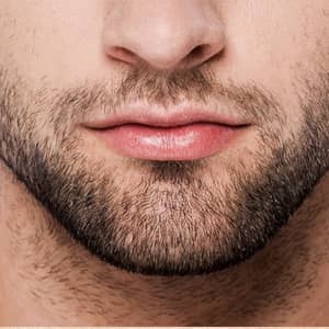 Facial Hair Transplant