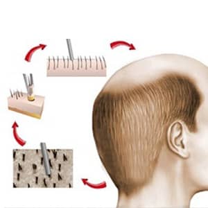 FUE Hair Transplant