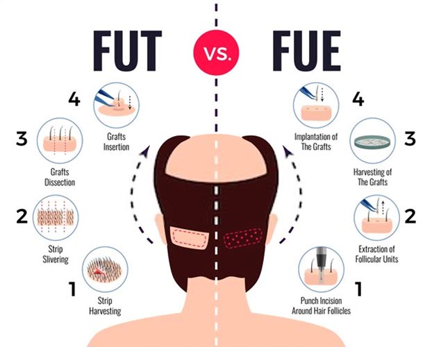 Types of Hair Transplant