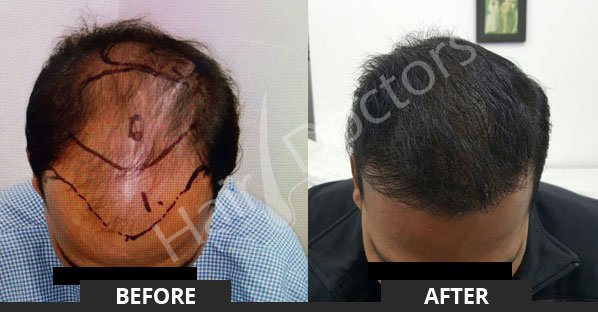 Hair Transplant 