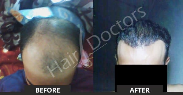 FUE Hair Transplant